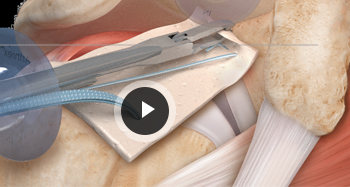 Reconstruction Procedure Video